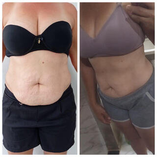 Aluna antes e depois: redução de gordura abdominal