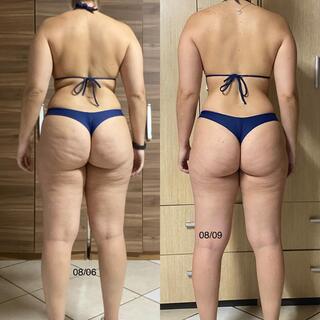 Aluna antes e depois: redução de flacidez
